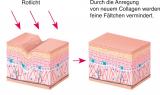 ✔ Verbesserte Direktbräune<br />
✔ Optimale Vitamin D Versorgung<br />
<strong>Mit rotem BeautyLight</strong><br />
✔ Sorgt für eine glatte und weiche Haut<br />
✔ Stimuliert die Collagenproduktion<br />
✔ Weniger Hautgeruch<br />
<br />
<strong>Lust auf eine sanfte Bräune und eine geschmeidig zarte Haut?</strong> Das Collarium® macht‘s möglich. Das einzigartige Konzept der Lichttherapie vereint das Wirkungsspektrum von UV- und Rotlicht. Das Rotspektrum fördert die Durchblutung und verbessert dabei die UV-Verträglichkeit. Ihre ausgewogene spektrale Verteilung verbessert die Direktpigmentierung um bis zu 50%. <strong>Das Resultat ist eine glatte, sanft gebräunte Haut und eine optimale Vitamin D Versorgung.</strong><br />
<br />
<strong>DIE URSACHEN DER HAUTALTERUNG</strong><br />
Mit steigendem Alter geht die Versorgung der Oberhaut mit Nährstoffen zurück. Das Resultat ist eine geringere Collagen- und Elastin-Produktion. Dies hat eine Erschlaffung der Haut zur Folge. Die verminderte Zellregeneration führt ausserdem zum Feuchtigkeitsverlust, Verlust von Elastizität und schliesslich zur Faltenbildung.<br />
<strong>WELCHE WIRKUNG HAT DAS ROTLICHT IN DER HAUT?</strong><br />
Klinische Studien haben gezeigt, dass sich Hautzellen bis zu 200 Prozent schneller regenerieren, wenn sie mit Collagen-Lampen behandelt werden. Das Rotlicht bekämpft also auf natürliche Weise die Ursachen der Hautalterung von innen und hemmt die Wirkung von freien Radikalen.<br />
<br />
<strong>SO NUTZEN SIE DAS COLLARIUM® RICHTIG:</strong><br />
Wenn Sie über 4 Wochen nicht mehr an der Sonne, im Solarium oder Collarium® waren, muss die Haut zuerst wieder Pigmente aufbauen. <strong>Erst ab der 3. bis 4. Besonnung stellt sich ein Bräunungsergebnis ein, je nach Hauttyp. </strong>Der Mindestabstand zwischen den Collarium®-Besuchen sollte mindestens 2 Tage betragen. Beachten Sie die angeschlagenen Hauttyp Tabellen. Personen unter 18 Jahren ist die Nutzung untersagt.